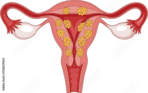 Vector medical illustration of female reproductive system showing uterus, ovaries, fallopian tubes, and abnormal growths for gynecology education.