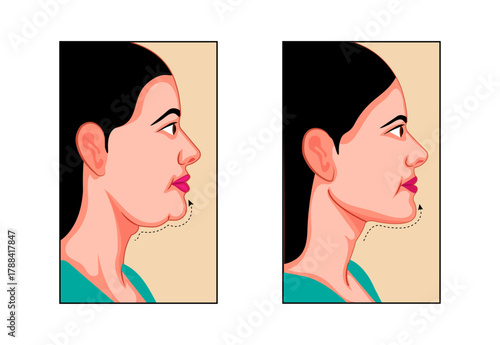 Face Fat Reduction Concept Illustration