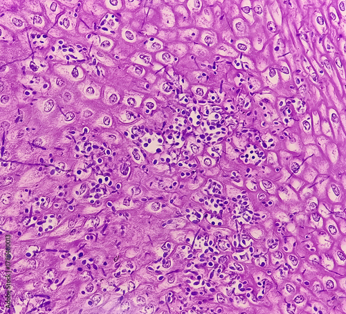Endoscopic biopsy of oesophagus, microscopically show hyperplastic oesophageal mucosa, fibrinopurulent exudate and many spores of candida. Candidiasis.