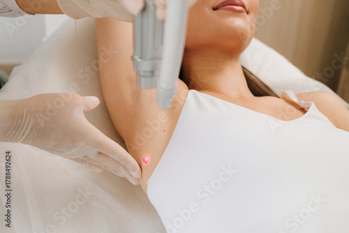 Laser mole treatment provides accurate skin correction. Laser Mole Removal close-up. Non-invasive laser mole therapy eliminates blemishes safely. Laser procedure removes unwanted mole tissue gently.