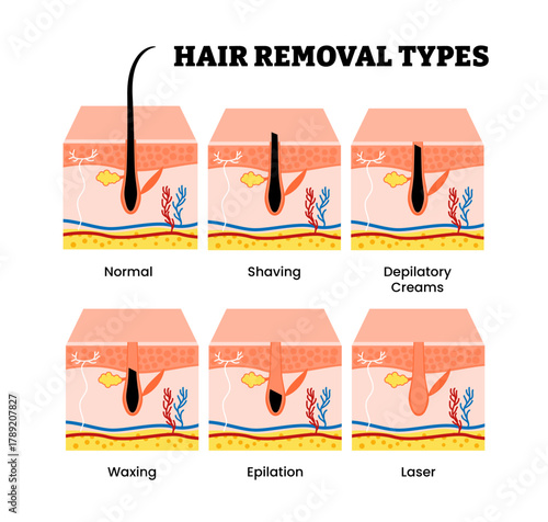 Different types of hair removal type. Labeled normal, shaving, depilatory creams, waxing, depilation, laser. Remove follicle. Dermatology concept. Vector illustration.