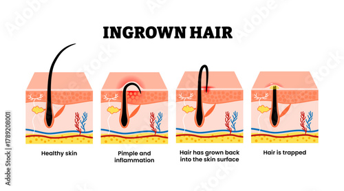 Different types of ingrown hair type set collection. Labeled healthy hair skin, pimple and inflammation, hair grown back into skin surface, hair is trapped. Dermatology and beauty concept illustration