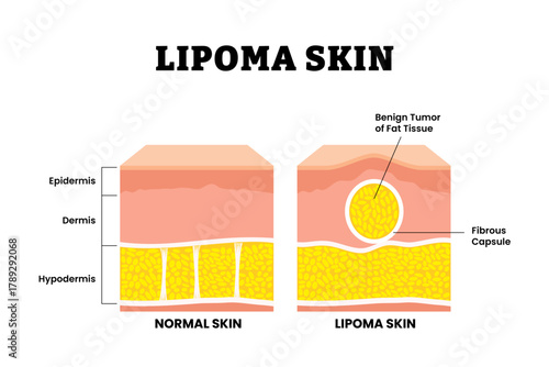 Normal vs Lipoma skin structure anatomy cross section. Benign tumor of fat tissue and fibrous capsule. Adipose tumor or Fatty lump. Medical poster diagram vector illustration.