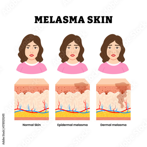 Different types of melasma skin types with woman girl character. Normal, epidermal and dermal melasma. Chloasma faciei, Hyperpigmentation, Skin structure anatomy cross section. Vector illustration.