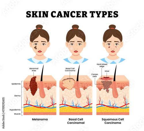 Different types of skin cancer type. Labeled woman or girl character, melanoma, basal cell carcinoma, squamous cell carcinoma, ulcer, tumor. Skin structure anatomy cross section. Vector illustration.