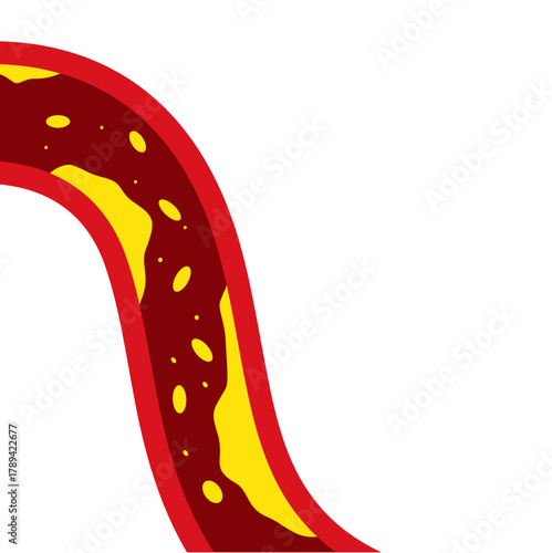 Medical Illustration of Cholesterol Buildup in Artery
