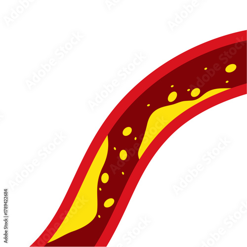 Medical Illustration of Cholesterol Buildup in Artery