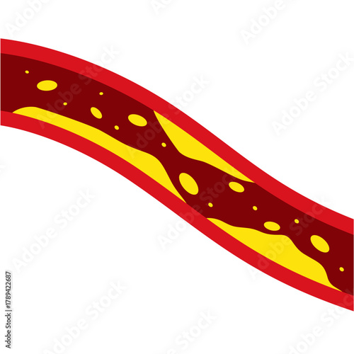 Medical Illustration of Cholesterol Buildup in Artery