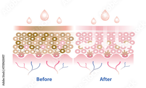 Before and after melasma treatment vector illustration isolated on white background. Cross section of melasma skin and skincare absorbing to help reduce hyperpigmentation, dark spots and damaged skin.