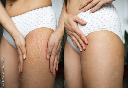 Fotografie Image compare before and after Woman skin stretch marks removal treatment, real people