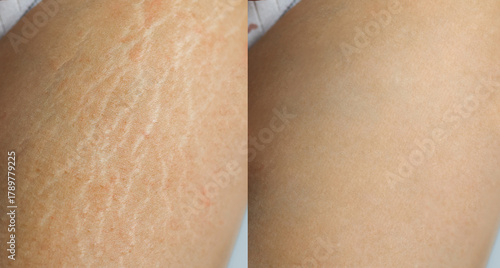 Image compare before and after Woman legs and hips with stretch marks removal treatment on white background.