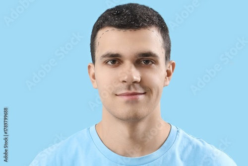 Young man with hair loss pr...