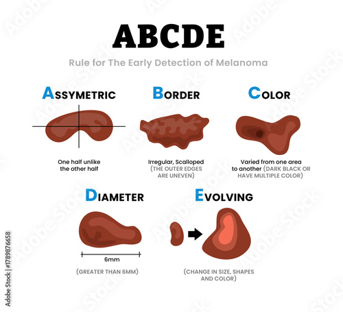 Different characteristics of skin damage. ABCDE Rule for the early detection of Melanoma. Assymetric, Border, Color, Diameter, Evolving. Human skin layers anatomy cross section. Vector illustration