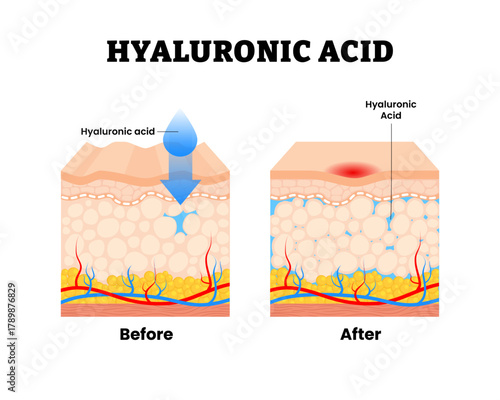 Before after hyaluronic acid procedure. Skin rejuvenation, Wrinkles and smoother surface for woman skincare. Anti aging beauty lifestyle. Human skin layers anatomy cross section. Vector illustration