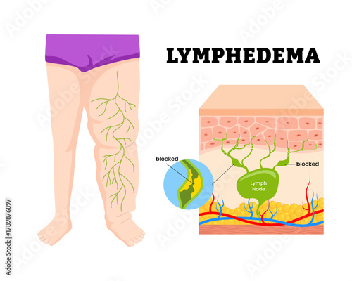 Lymphedema. buildup of lymph fluid, blocked lymph node on leg. Lymphatic system is blocked or damaged that cause swollen leg. Human skin layers anatomy cross section. Vector illustration