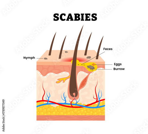 Scabies mite skin structure. Labeled nymph, feces, eggs, burrow. Contagious skin infestation by the mite Sarcoptes scabiei. Human skin layers anatomy cross section. Vector illustration