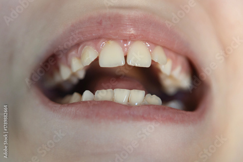 Close-up view of a child's mouth showing baby teeth and gaps, highlighting dental development and growth stages
