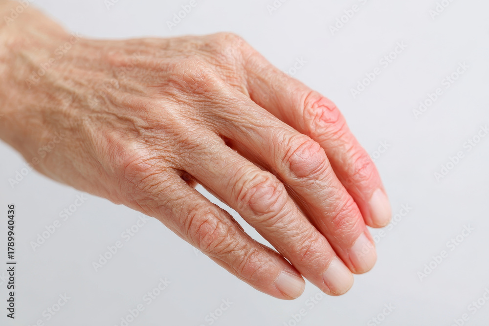Fototapeta premium Elderly hand, arthritis, pain, inflammation, finger, joint, skin
