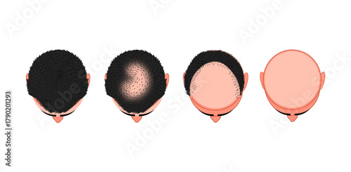 Hair Loss Stages Illustration – Set of Four Stages of Male Alopecia