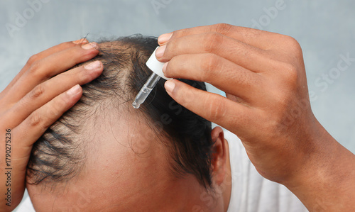 Εκτύπωση καμβά An Asian man is dripping with pipette a hair nourishing serum on a thinning head area