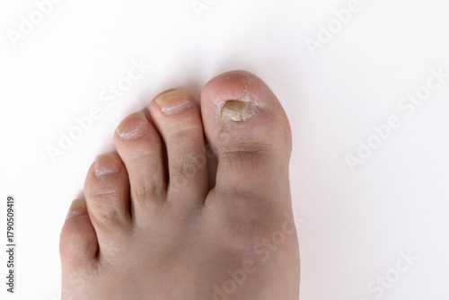 Big toe after treatment for an ingrown toenail. The nail bed is clean and healing, with new nail growth visible. Suitable for medical education, podiatry training, or healthcare articles.