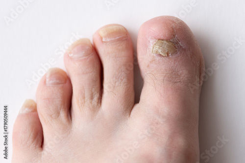 Detailed view of a patient’s toe recovering after ingrown toenail removal. The nail shows signs of regrowth despite chemical burn treatment, ideal for podiatry, wound management, clinical education