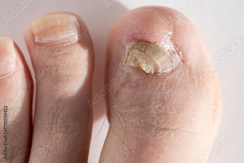 Close up of a healing big toe after ingrown toenail surgery. The toenail has been removed, with new nail growth visible. Ideal for medical, podiatry, and healthcare illustrations for nail surgery