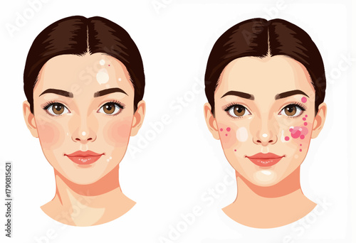 Illustrative Comparison of Skincare Effects on Facial Blemishes: Clear Skin Transformation Through Treatment of Acne and Pigmentation Issues