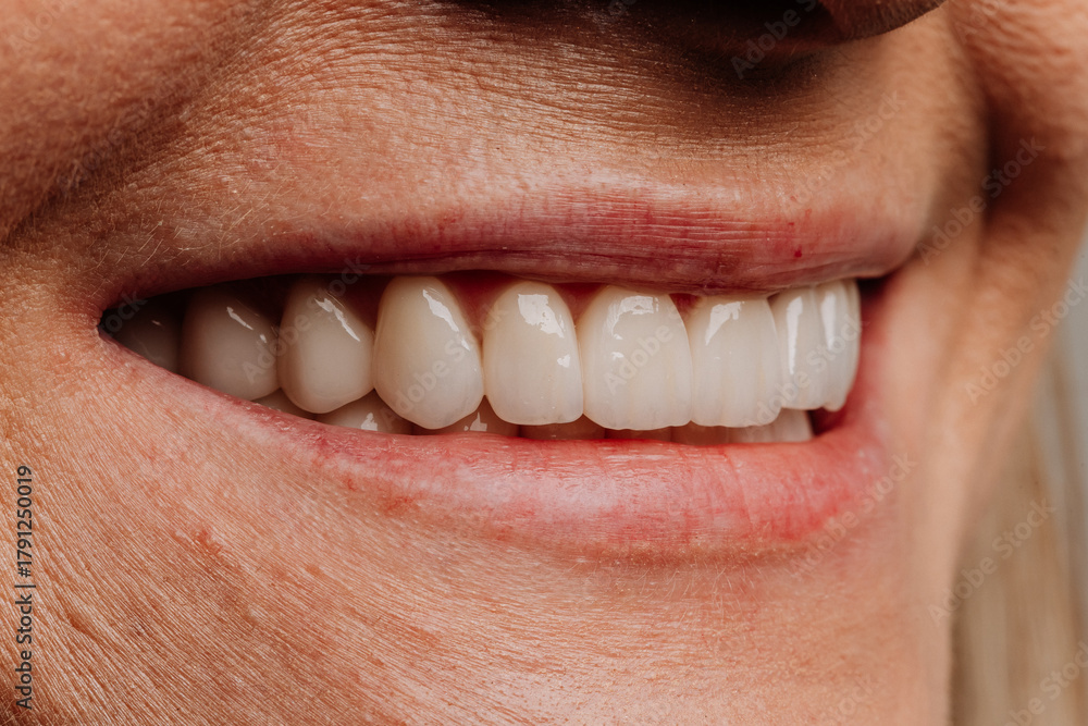 Fototapeta premium Closeup of bright white veneers on mature woman smile, natural dental result