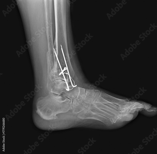 X-ray fracture of the tibia fixed with metal plate and screws