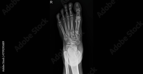 Foot x-ray radiograph showing bones, toes, metatarsals and ankle joint. Dorsal view plain film for diagnostic examination of foot skeletal structure and bone anatomy