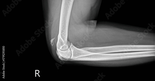Forearm x-ray radiograph showing radius, ulna and elbow joint. Lateral view plain film for diagnostic examination of forearm bone structure and skeletal anatomy