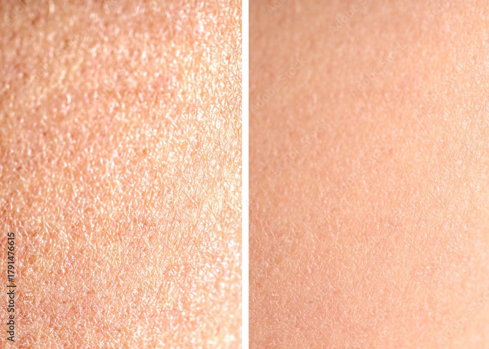 Fototapeta premium Dry skin before and after moisturizing, marco view. Collage for comparison