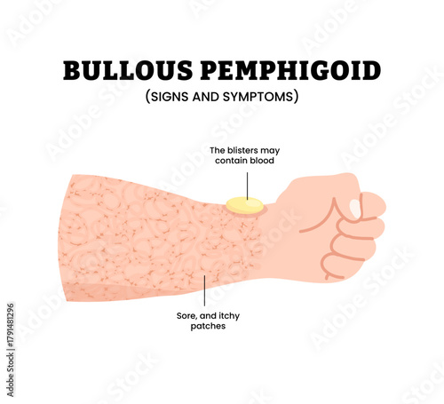 Bullous Pemphigoid skin disease signs and symptom with arm or hand. Rare autoimmune disorder causing blisters and sore, itchy, patches. Skin problem condition. Dermatology concept. Vector illustration