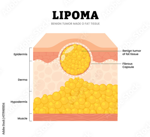  Lipoma skin structure anatomy cross section. Benign tumor of fat tissue and fibrous capsule. Adipose tumor or Fatty lump. Medical poster diagram vector illustration.