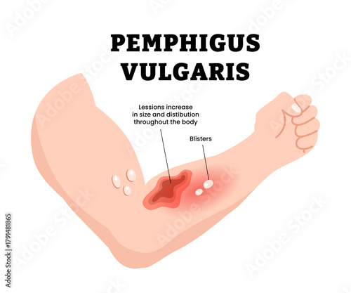 Pemphigus vulgaris disease signs and symptom with arm or hand. Rare autoimmune disorder causing blisters. Lesion increase. Skin problem condition. Dermatology concept. Vector illustration