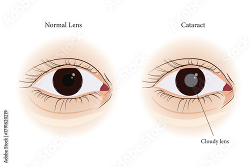 Medical illustration comparing normal eye lens and cataract with cloudy lens. eps 10