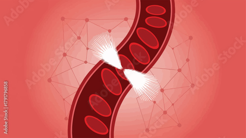 High Blood Pressure Blood Vessel Medical Illustration Hypertension