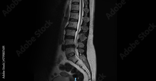 MRI of lumbar spine showing vertebrae, intervertebral discs and spinal cord. Sagittal view magnetic resonance imaging for diagnostic examination of lower back and spine anatomy