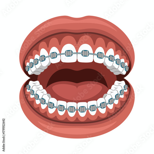 Close up illustration of a human mouth with clear dental braces on teeth