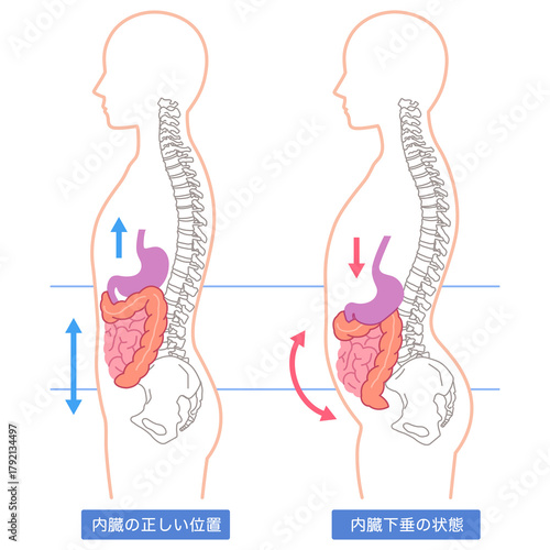 内臓下垂　内臓の位置が下がっている状態