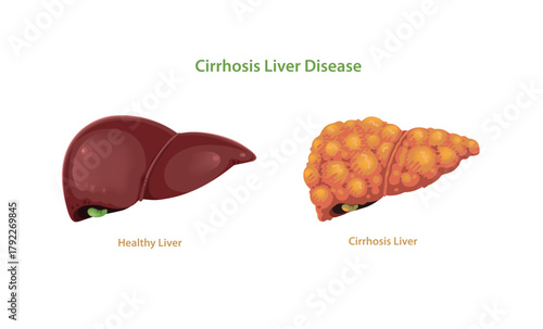 Cirrhosis Liver Disease