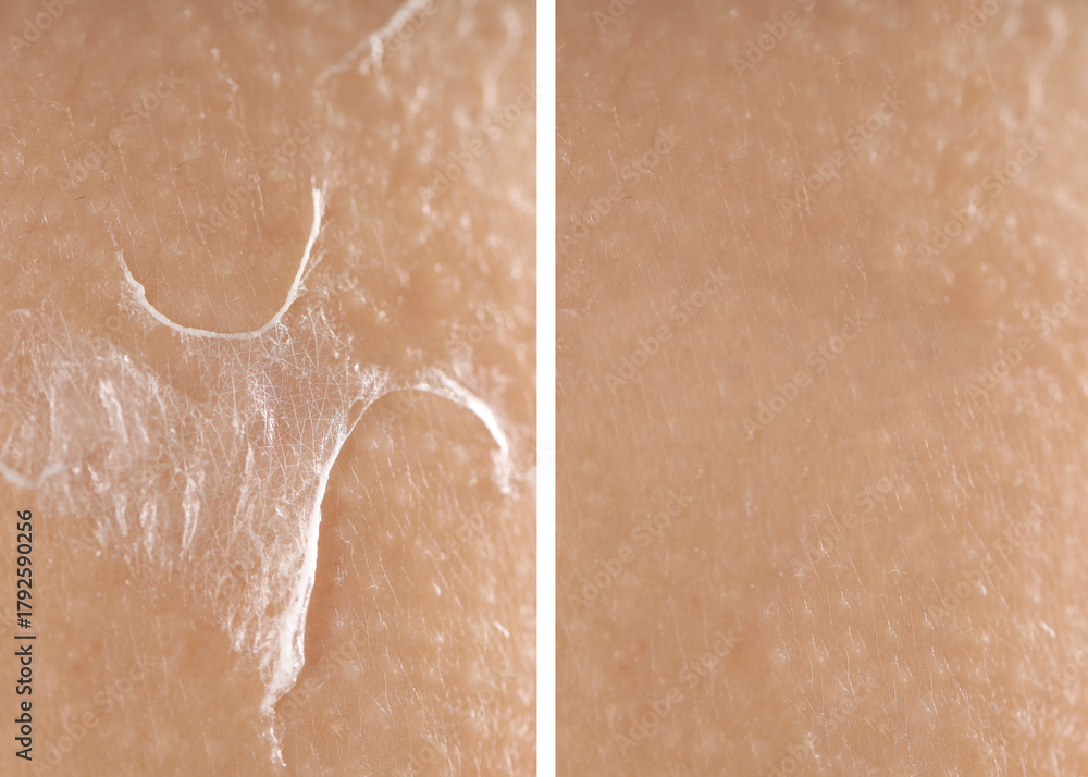 Fototapeta premium Dry skin before and after moisturizing, marco view. Collage for comparison
