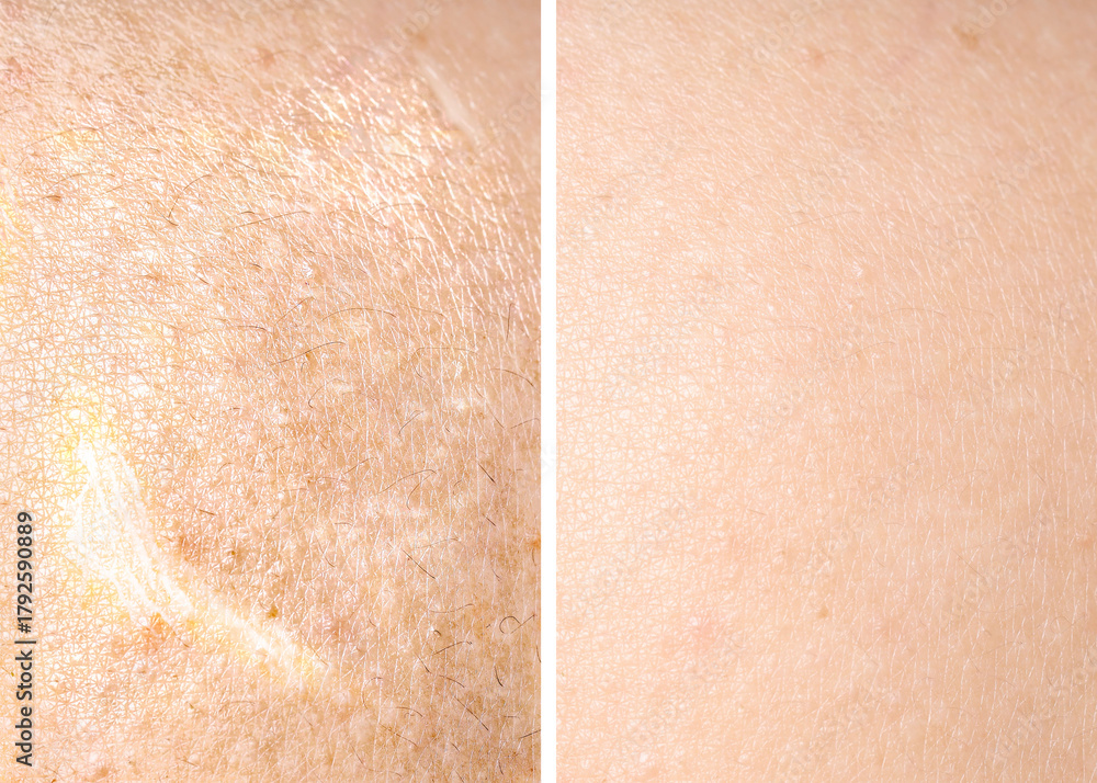 Fototapeta premium Dry skin before and after moisturizing, marco view. Collage for comparison