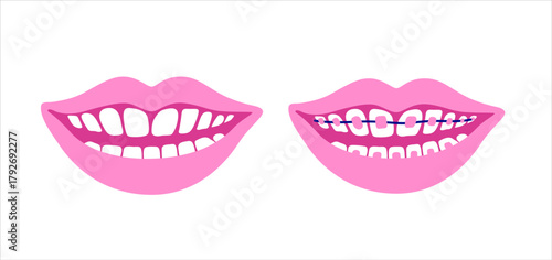Smiling mouth with dental braces. Smiling teeth. Orthodontic Treatment Concept. Vector isolated illustration.