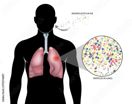 Microplastics Inhalation and Lung Accumulation Medical Illustration. Human Respiratory System Contaminated by Airborne Microplastics Diagram. Microplastic Particles Inside Lungs 