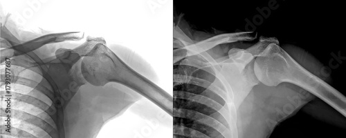 Shoulder Lateral View X-Ray Radiograph Showing Bone Structure and Diagnosis of Degenerative Diseases, Injury Prediction Isolated on Transparent Background