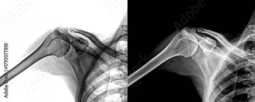 Shoulder Lateral Projection X-Ray Image Depicting Glenohumeral Joint of Degenerative Conditions Isolated on Transparent Background