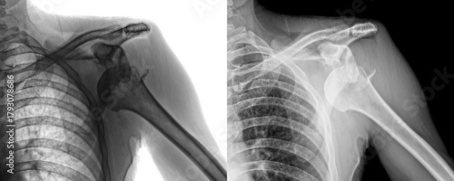 Lateral Shoulder X-Ray Radiograph Showing Glenoid Cavity and Humeral Head Alignment for Assessment of Degenerative Diseases and Isolated on Transparent Background