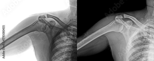 Shoulder Lateral X-Ray Radiograph Displaying Bone Structure Diagnosis of Degenerative Disorders and Injury Prognosis Isolated on Transparent Background